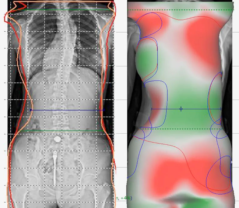 Customized Spinal Orthopedics