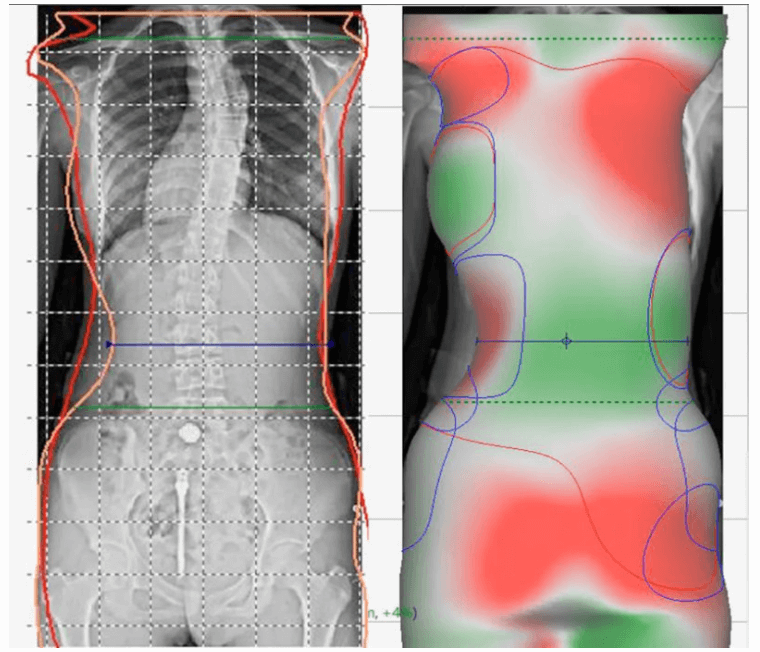 Acquisition of 3D spine data-1