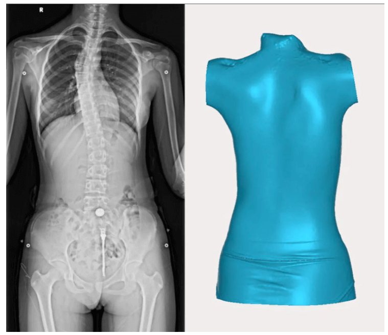 Acquisition of 3D spine data