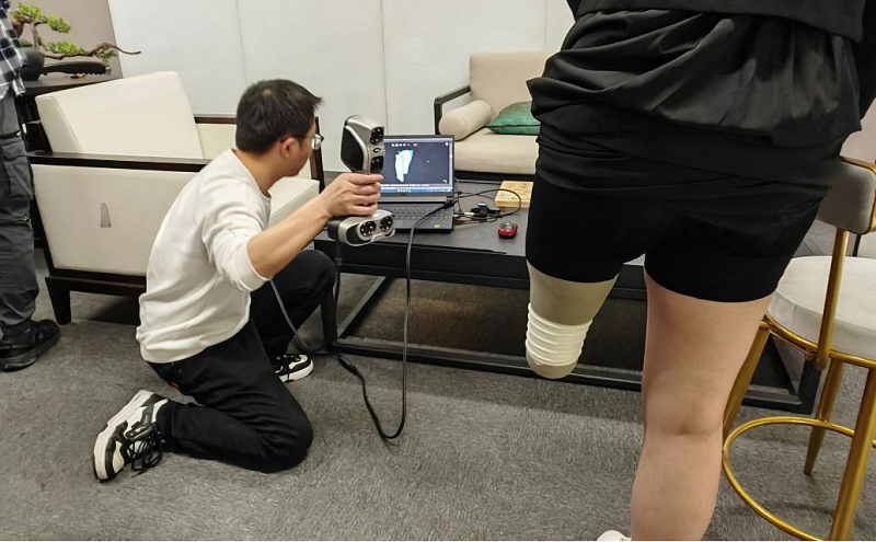 3D Scanning Residual Limb